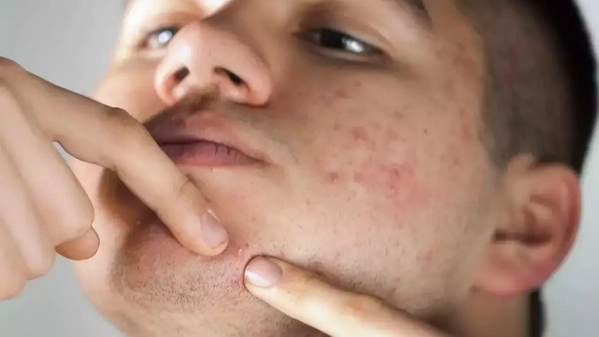 Adult Acne