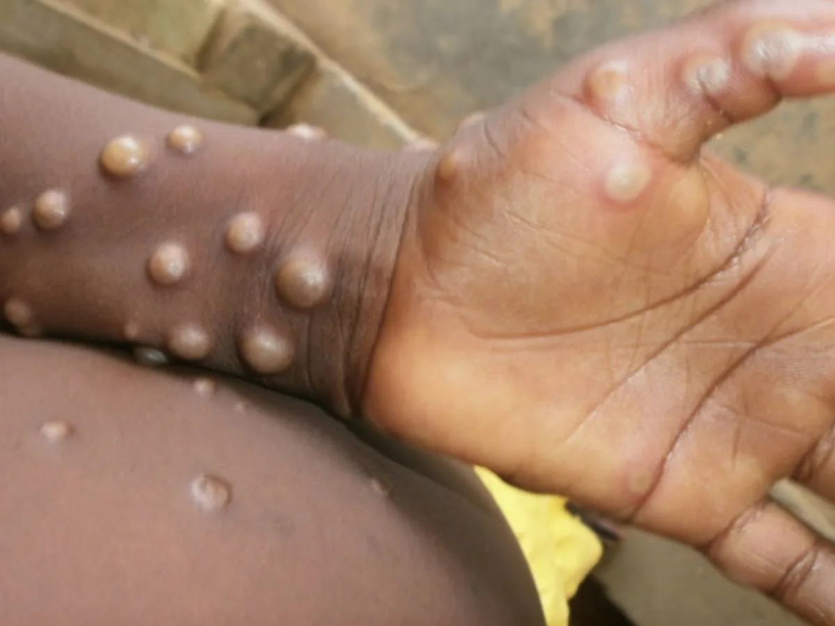 MONKEYPOX