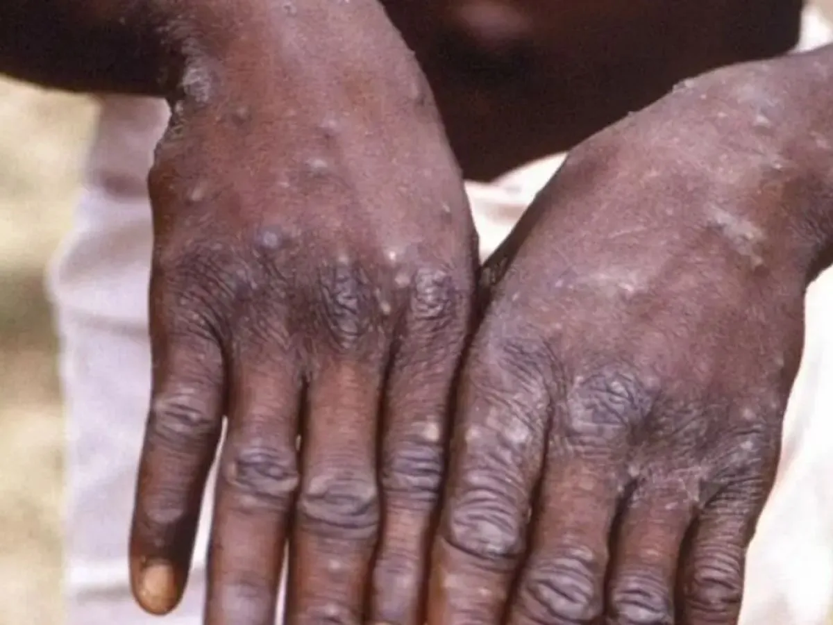 MONKEYPOX