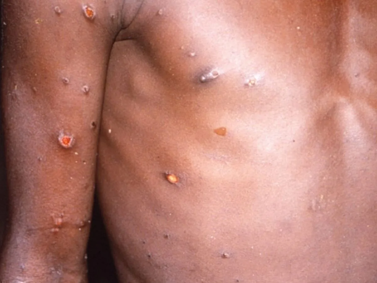 MONKEYPOX