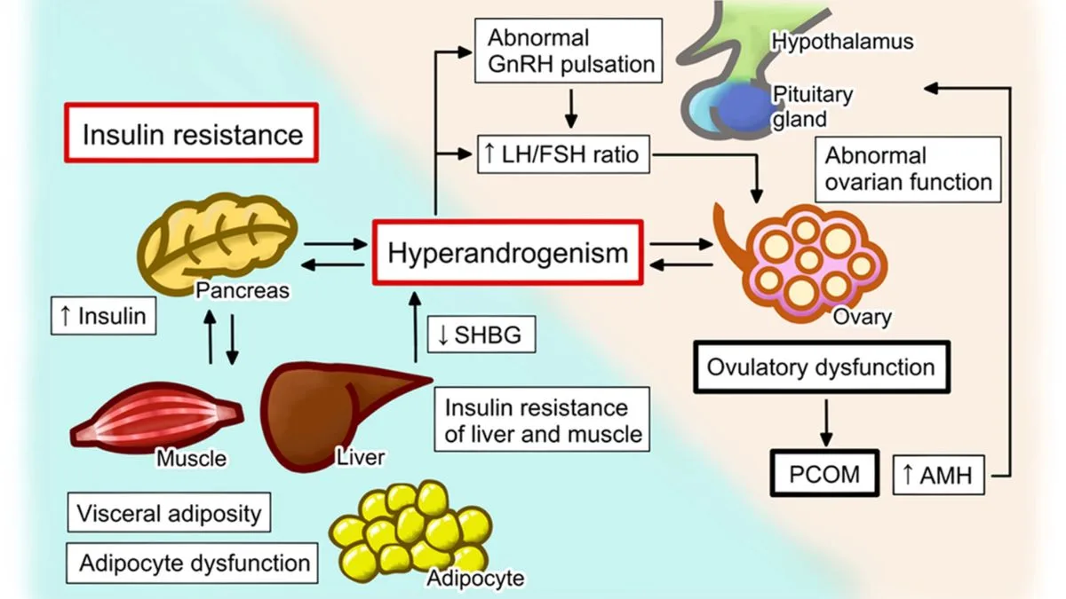 Polycystic ovarian syndrome (PCOS) is a hormonal imbalance that can result in infertility, irregular periods, and other health issues. Insulin resistance is a common feature of PCOS, and it can lead to diabetes and heart disease. Learn how to manage PCOS with a balanced diet, exercise, stress management, and weight loss
