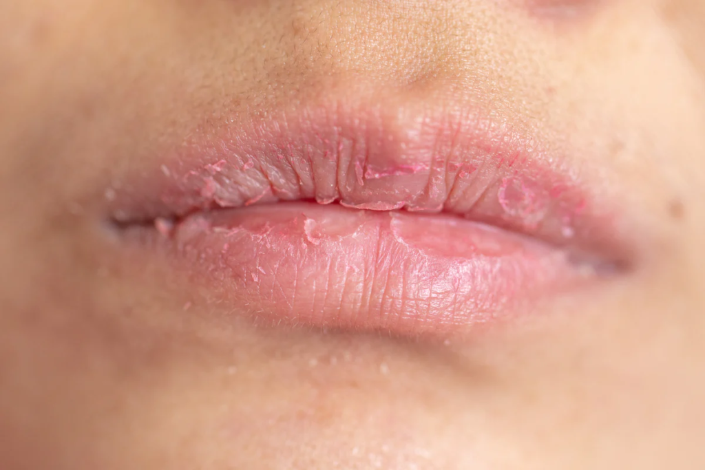 "Combat chapped lips this winter with expert-recommended tips. Learn how to keep your lips soft and supple even in the coldest months."
